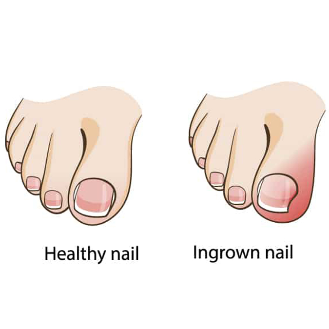 Ingrown toenail