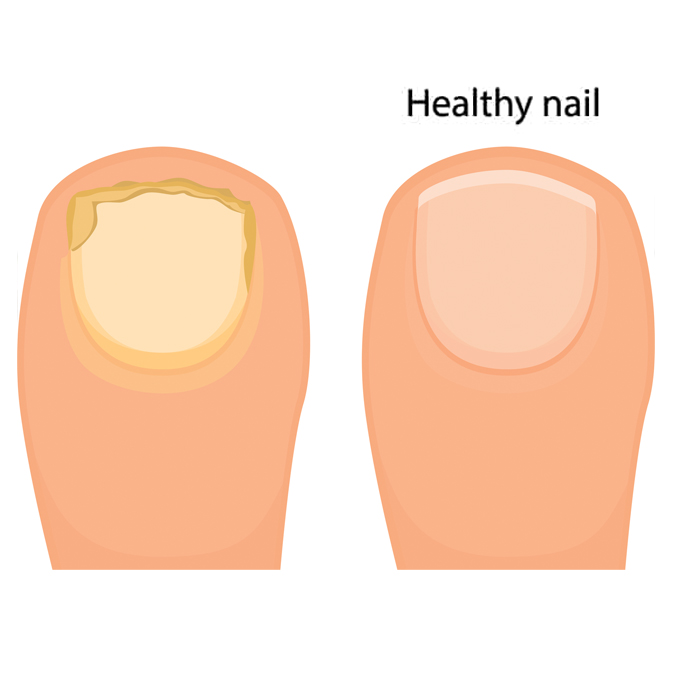 Toenail Fungus