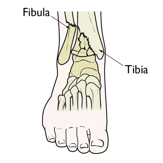 Ankle fracture