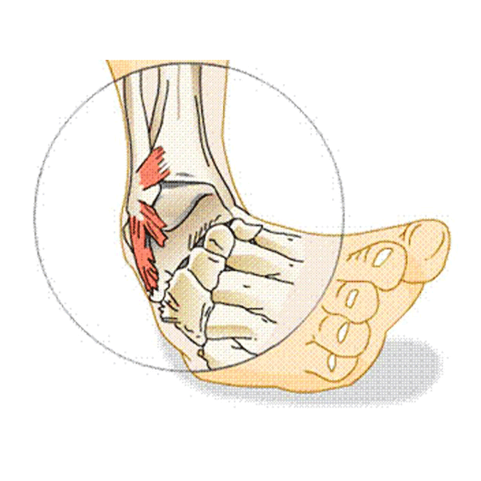 Ankle instability