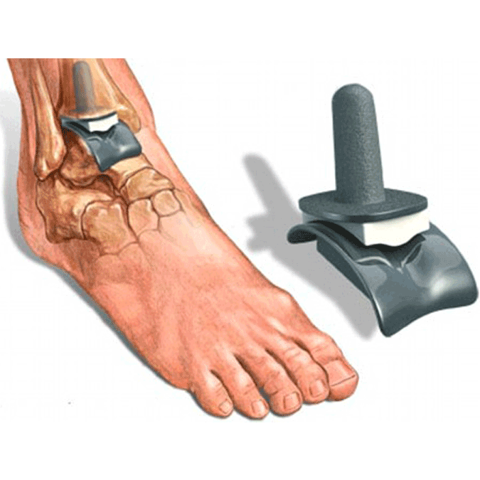 Ankle replacement