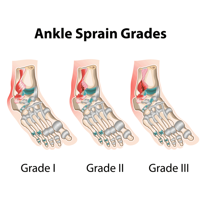 Ankle sprain grades