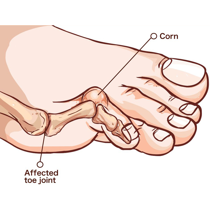 Hammer Toe