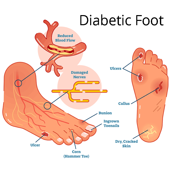 Diabetic foot