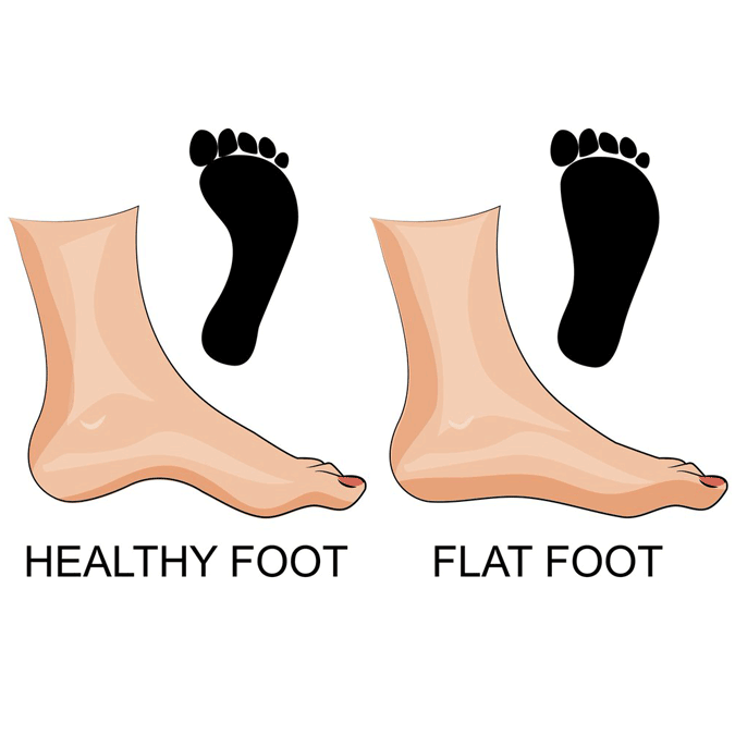 Flat foot vs healthy foot