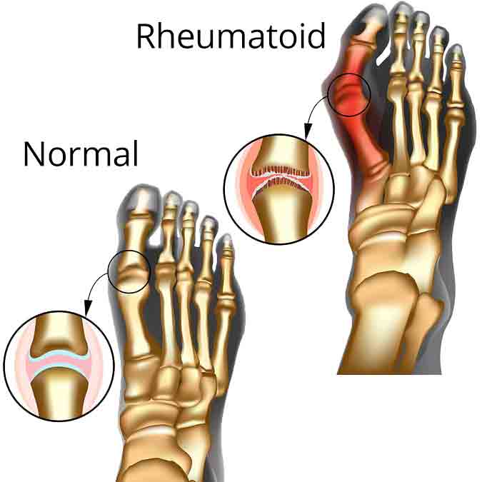 Rheumatoid Arthritis