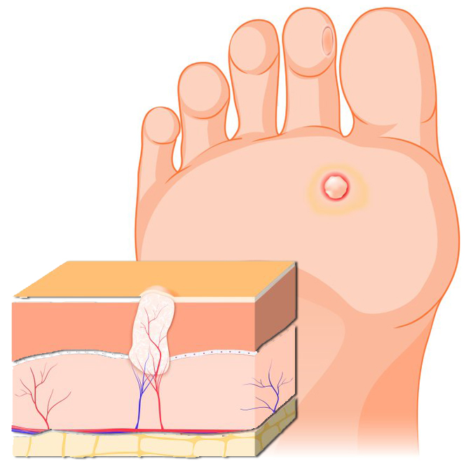 Plantar Warts