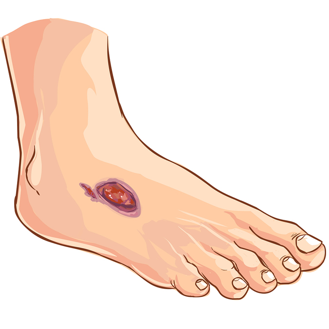 Foot wound